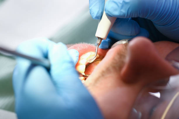 Best Emergency Treatment for Dental Infections or Abscesses in Succasunna, NJ