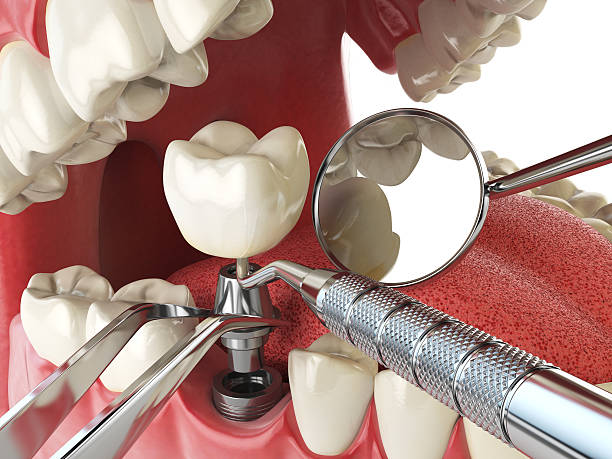 Best Emergency Gum Treatment in Succasunna, NJ